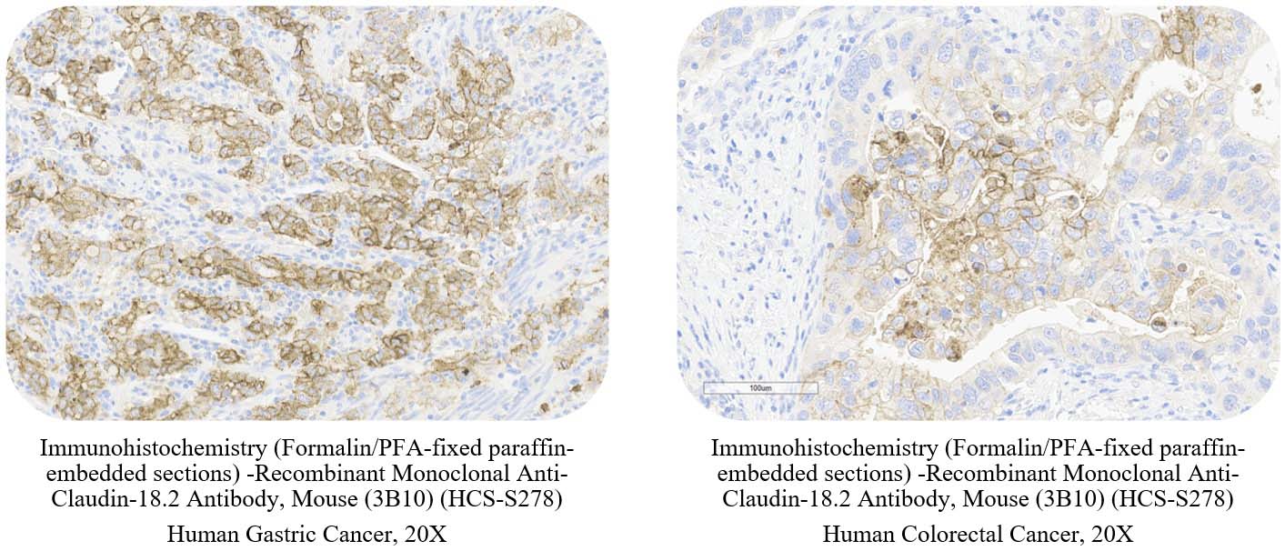 Claudin-18.2 CANCER SAMPLE