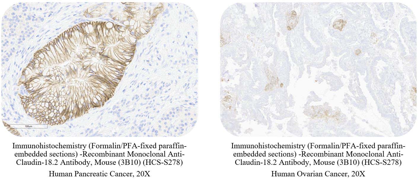 Claudin-18.2 CANCER SAMPLE