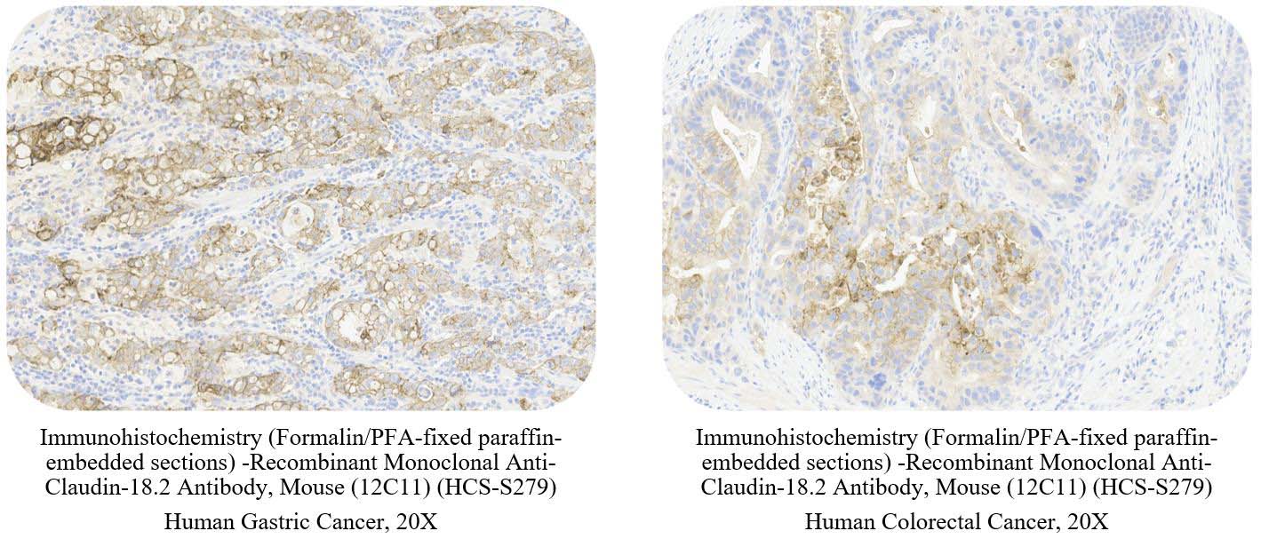 Claudin-18.2 CANCER SAMPLE