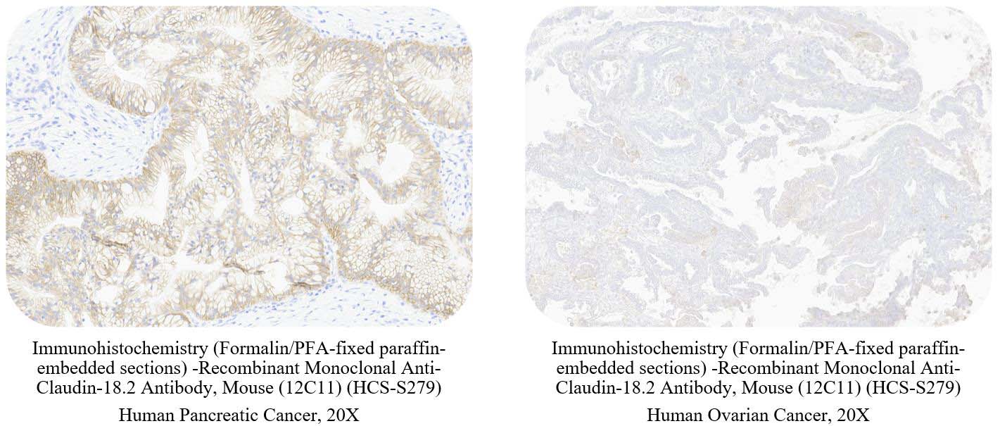 Claudin-18.2 CANCER SAMPLE