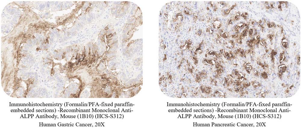 ALPP CANCER SAMPLE