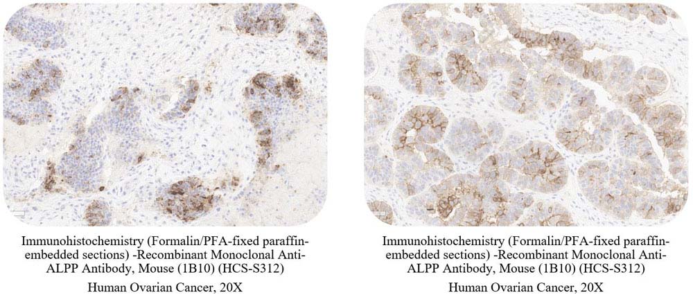 ALPP CANCER SAMPLE