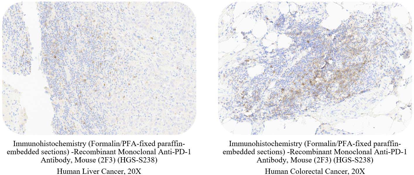 PD-1 CANCER SAMPLE