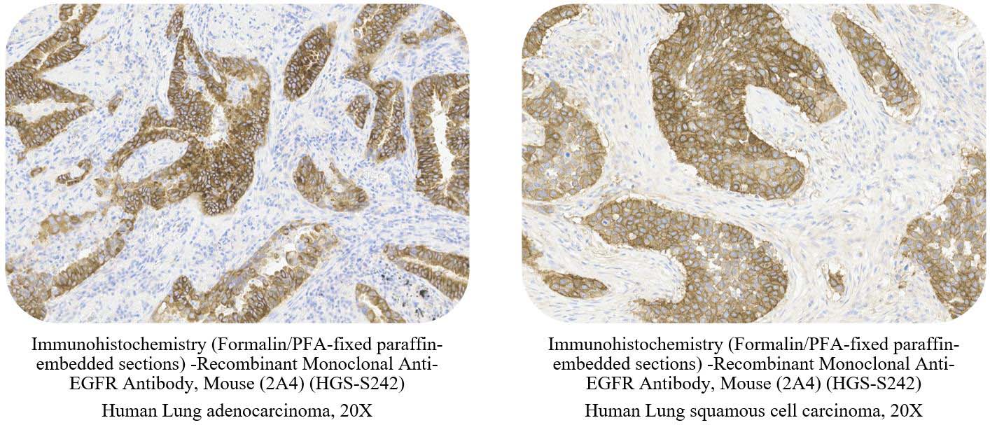 EGFR CANCER SAMPLE