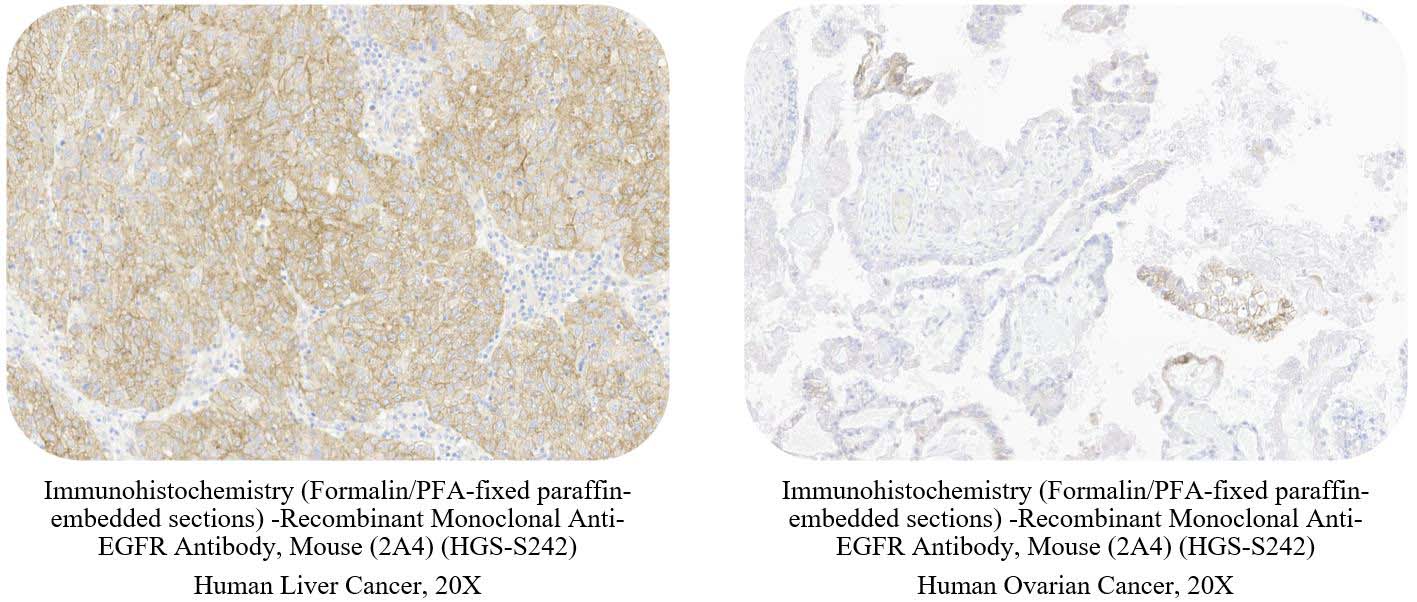 EGFR CANCER SAMPLE