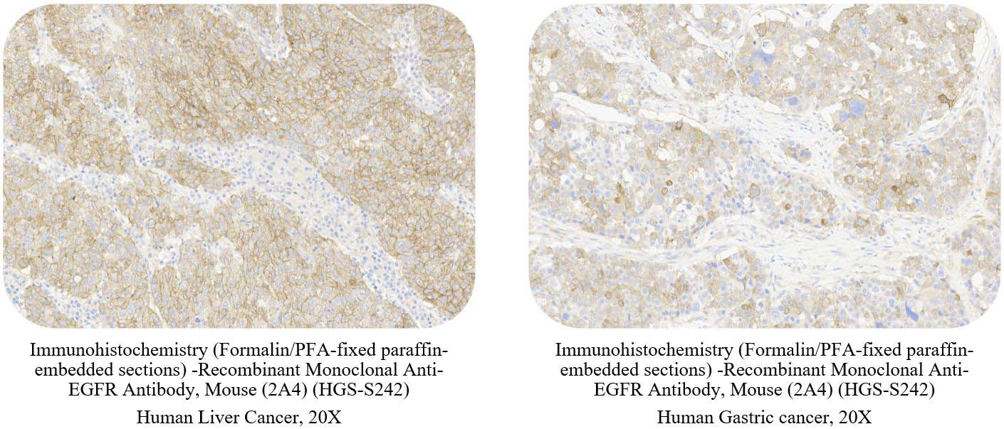 EGFR CANCER SAMPLE