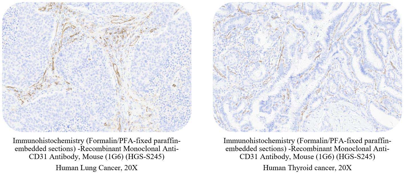 CD31 CANCER SAMPLE