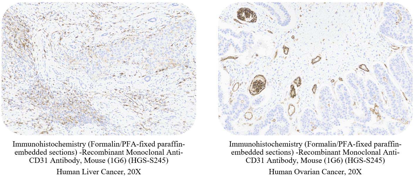 CD31 CANCER SAMPLE