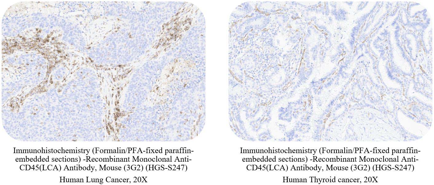 CD45 (LCA) CANCER SAMPLE