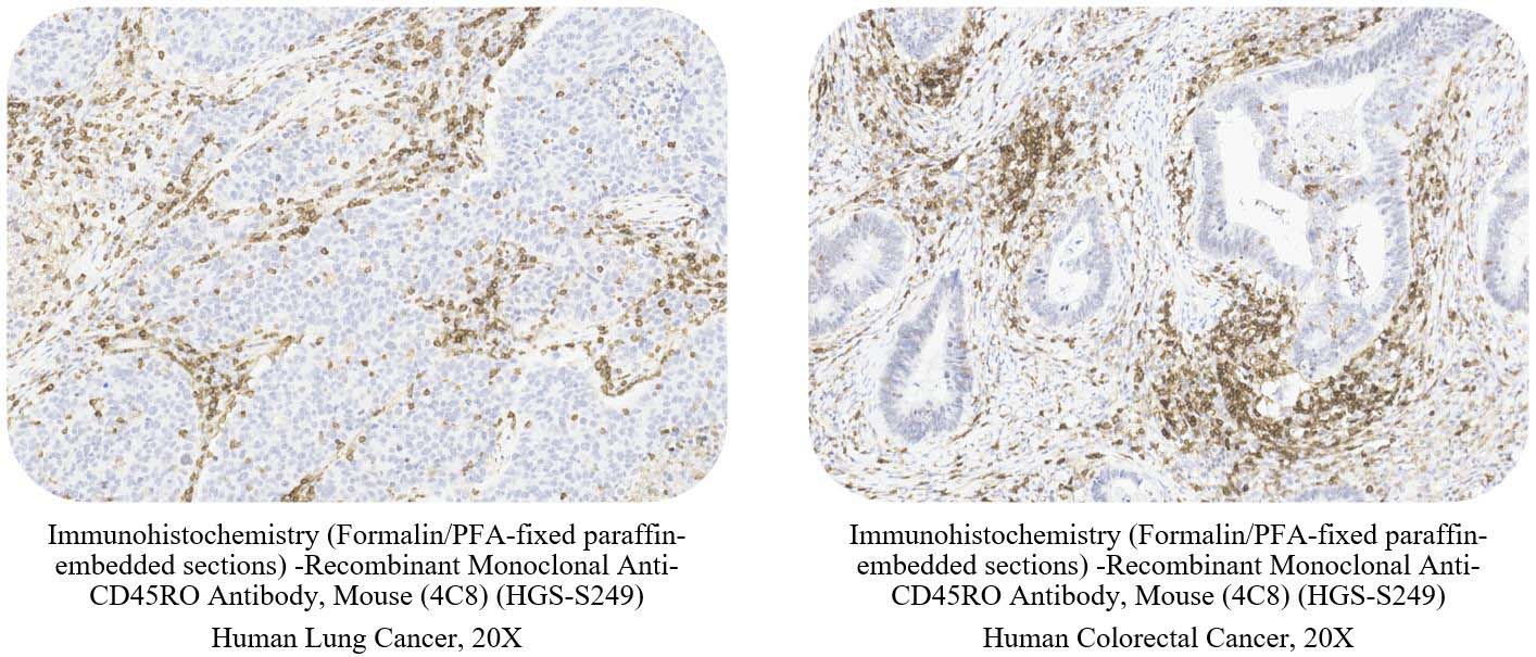 CD45RO CANCER SAMPLE