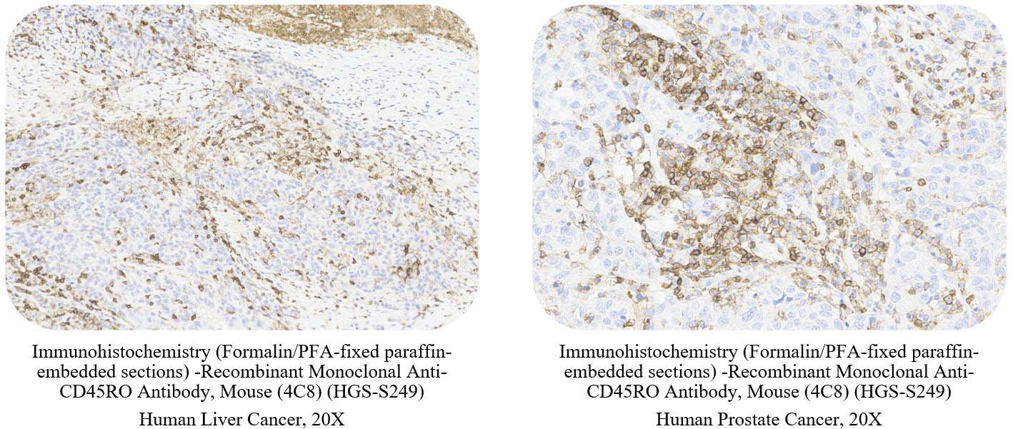 CD45RO CANCER SAMPLE