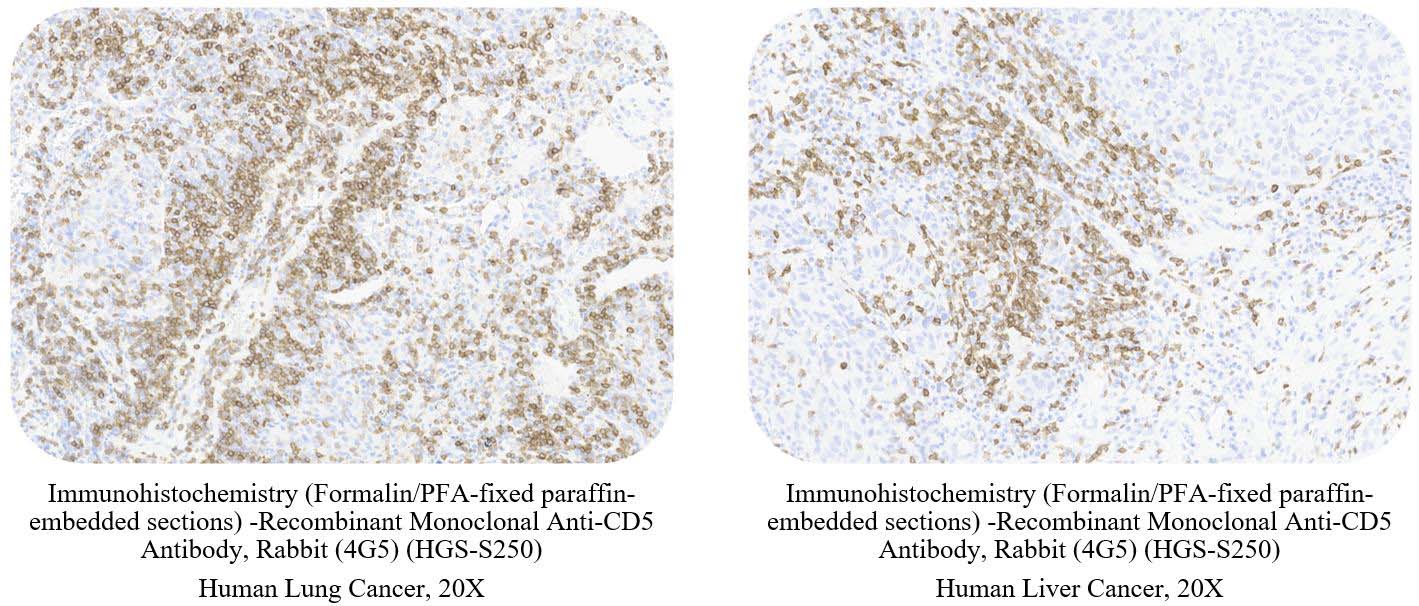 CD5 CANCER SAMPLE