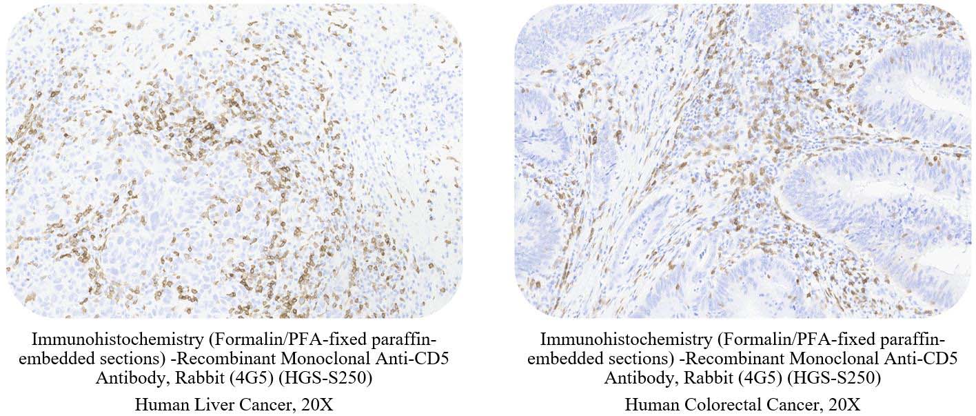 CD5 CANCER SAMPLE