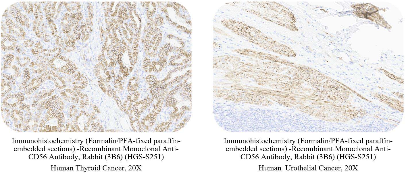 CD56 CANCER SAMPLE