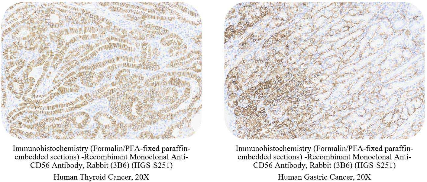 CD56 CANCER SAMPLE