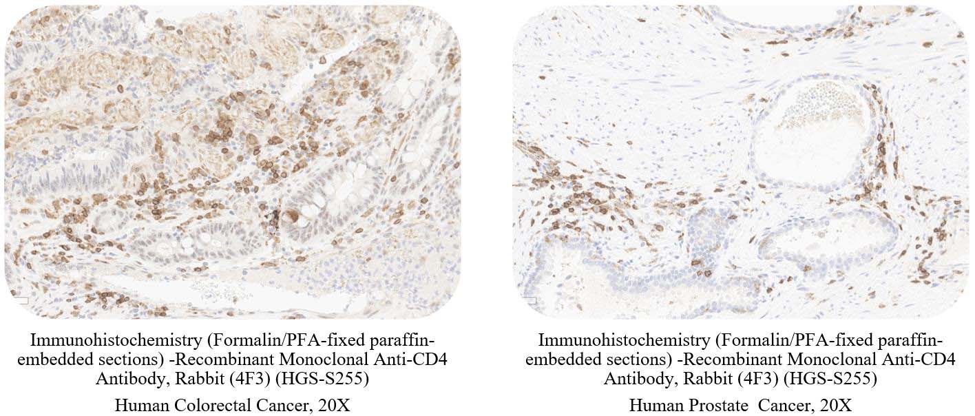 CD4 CANCER SAMPLE