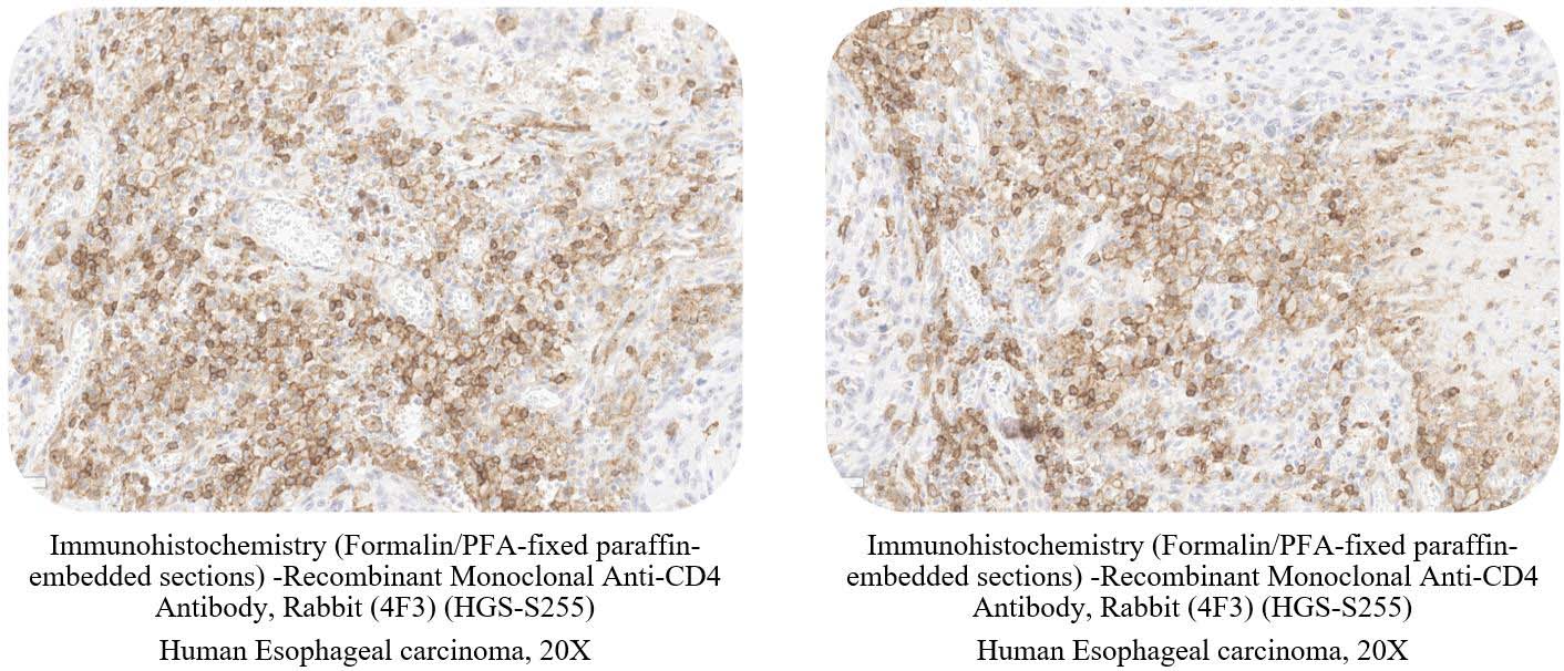 CD4 CANCER SAMPLE