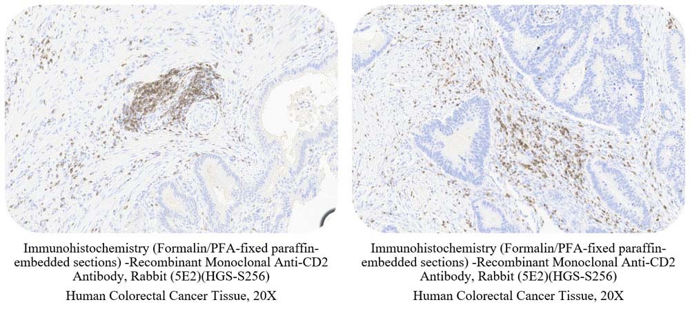 CD2 CANCER SAMPLE