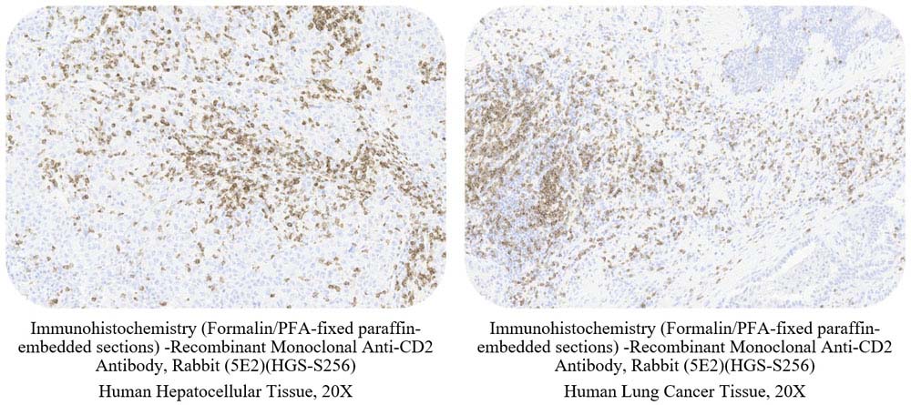 CD2 CANCER SAMPLE