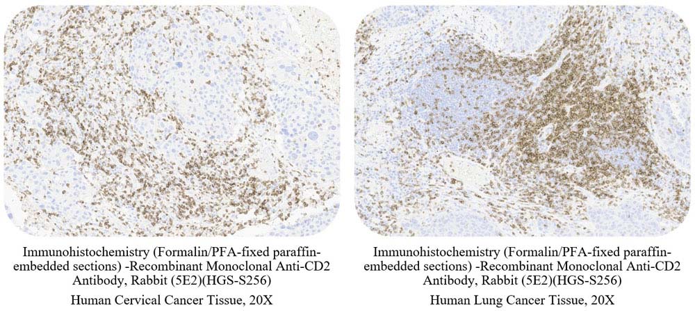 CD2 CANCER SAMPLE