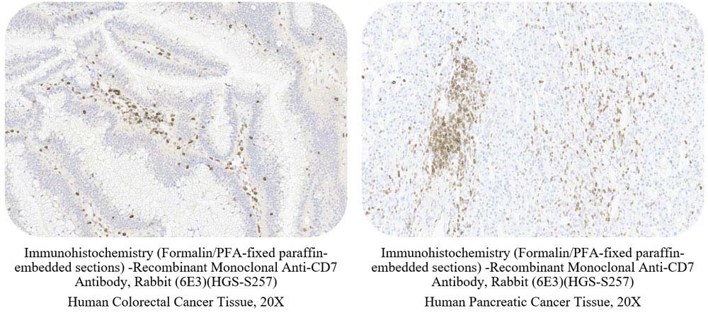 CD7 CANCER SAMPLE