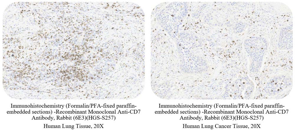 CD7 CANCER SAMPLE