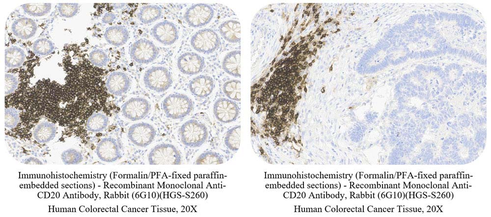 CD20 CANCER SAMPLE