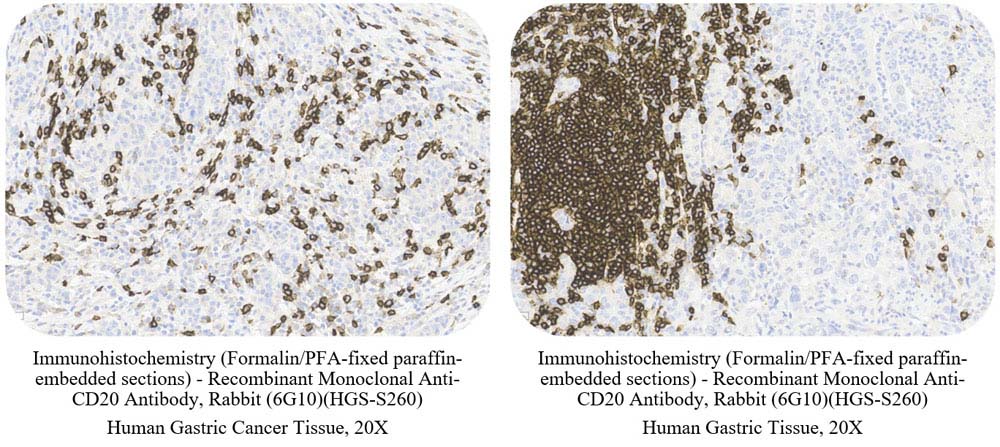 CD20 CANCER SAMPLE