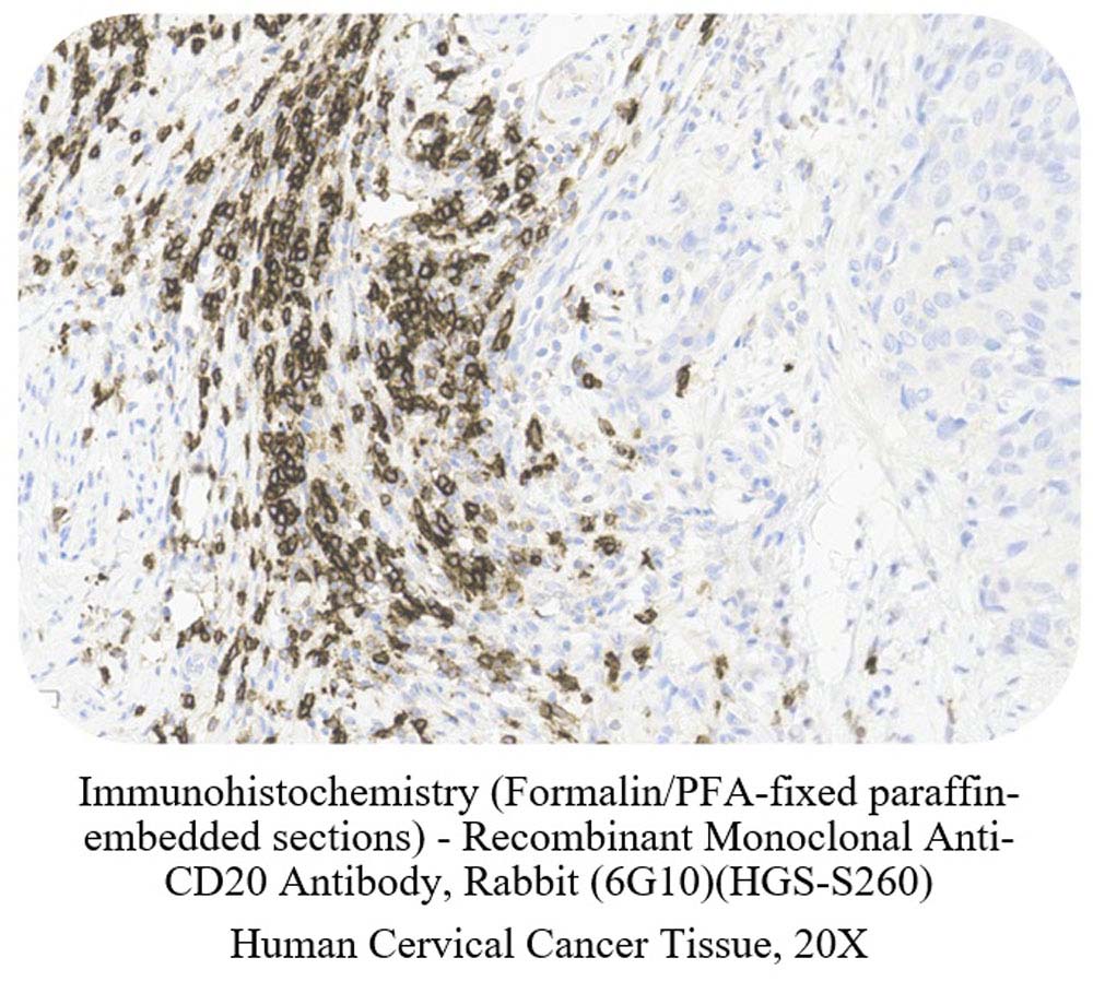 CD20 CANCER SAMPLE