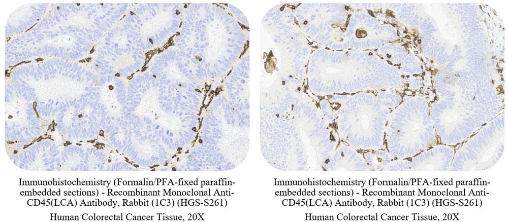 CD45 (LCA) CANCER SAMPLE