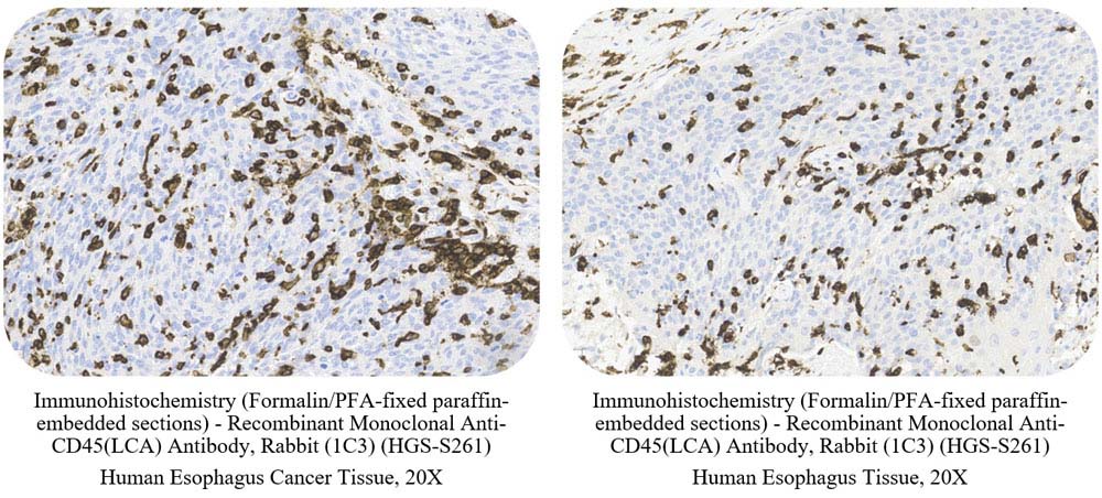 CD45 (LCA) CANCER SAMPLE