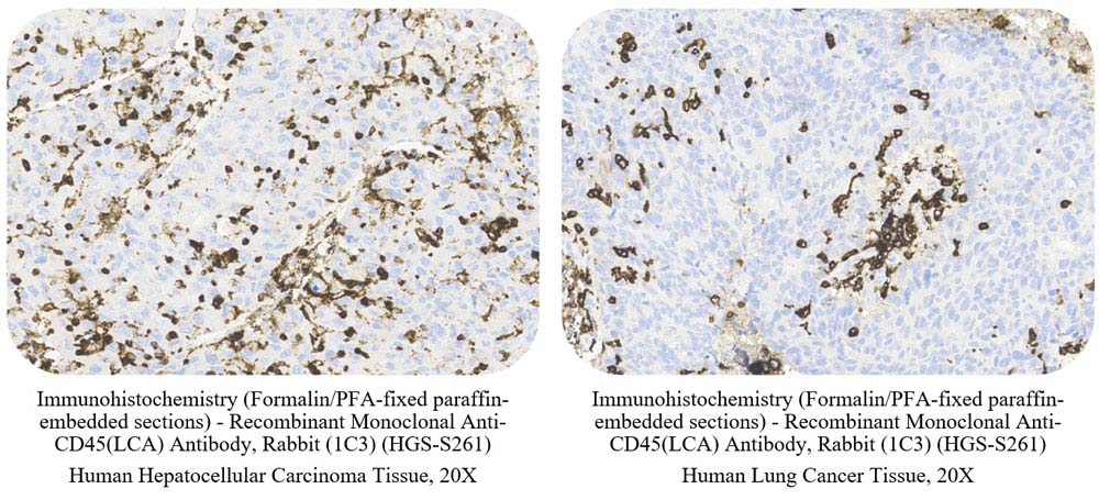 CD45 (LCA) CANCER SAMPLE