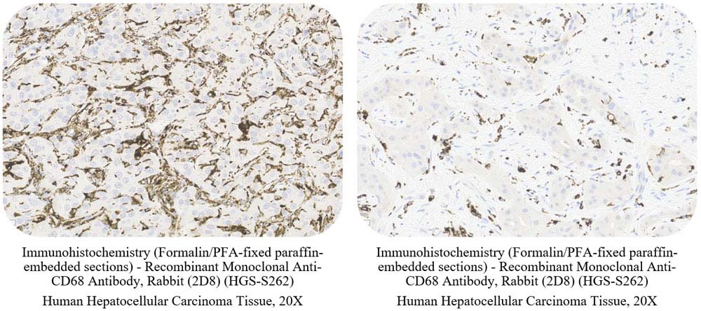 CD68 CANCER SAMPLE