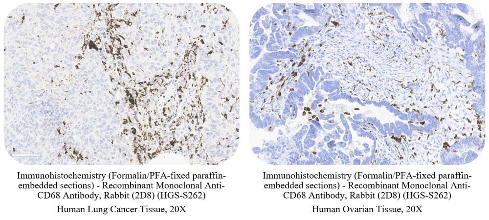 CD68 CANCER SAMPLE