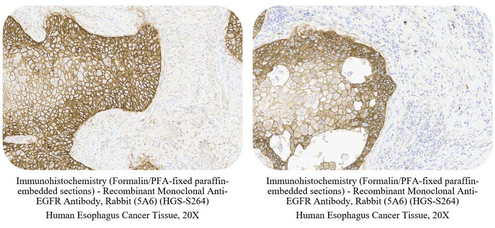 EGFR CANCER SAMPLE