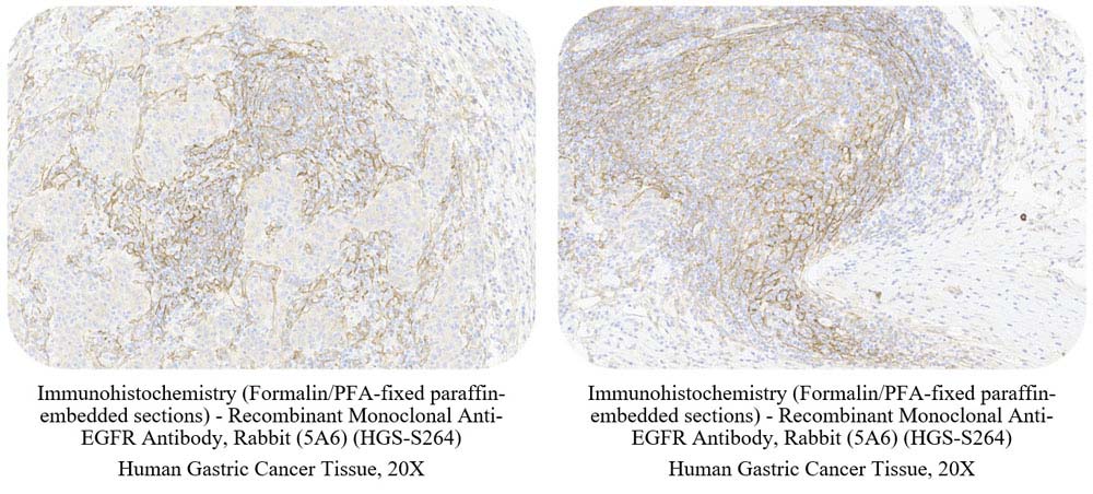 EGFR CANCER SAMPLE