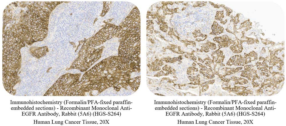 EGFR CANCER SAMPLE