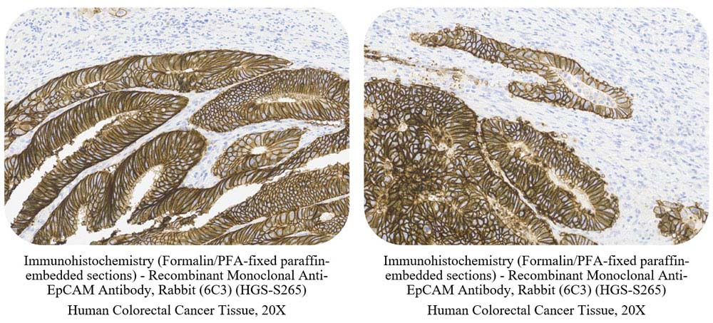 EpCAM CANCER SAMPLE