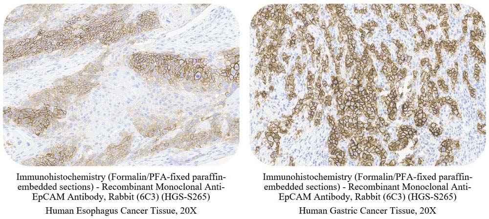 EpCAM CANCER SAMPLE