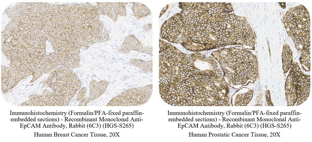 EpCAM CANCER SAMPLE