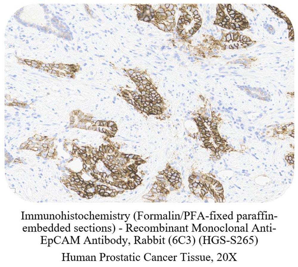 EpCAM CANCER SAMPLE