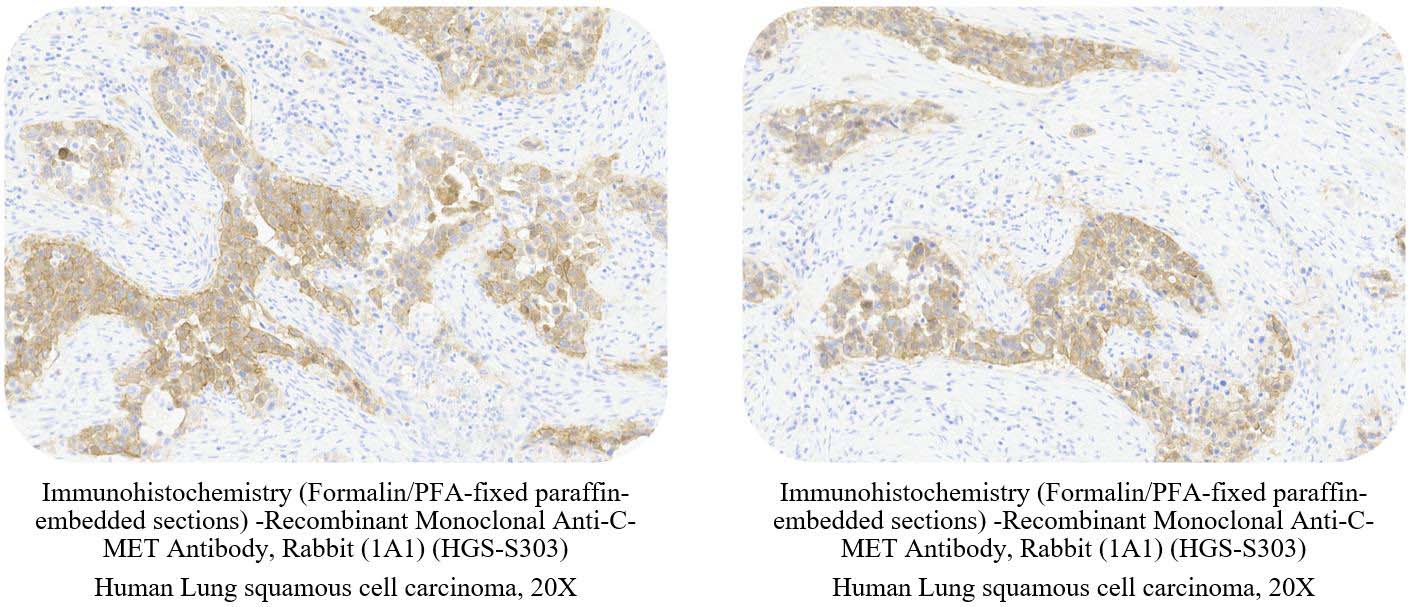 C-MET CANCER SAMPLE