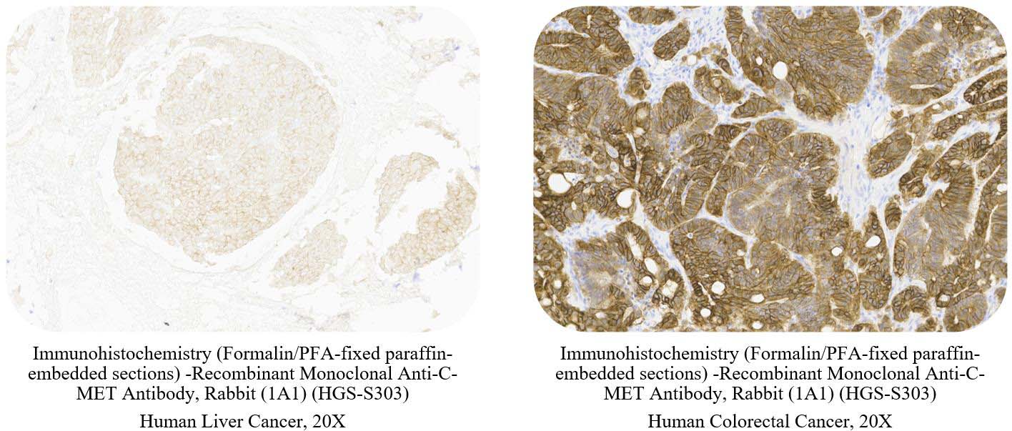 C-MET CANCER SAMPLE