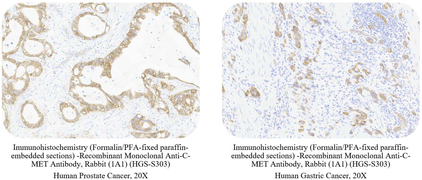 C-MET CANCER SAMPLE