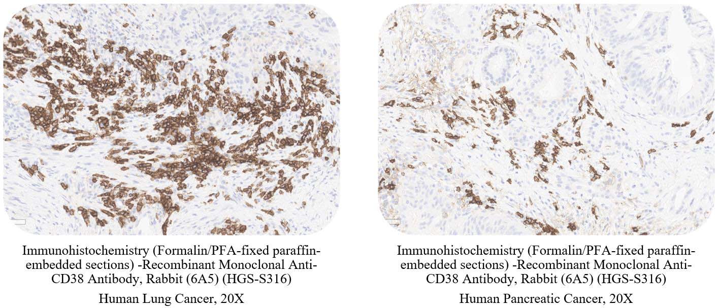 CD38 CANCER SAMPLE