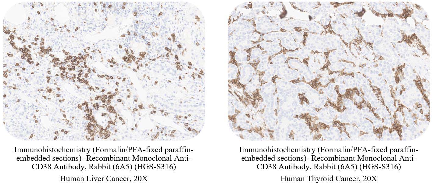 CD38 CANCER SAMPLE