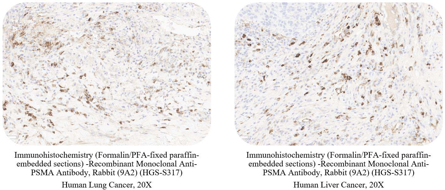 PSMA CANCER SAMPLE