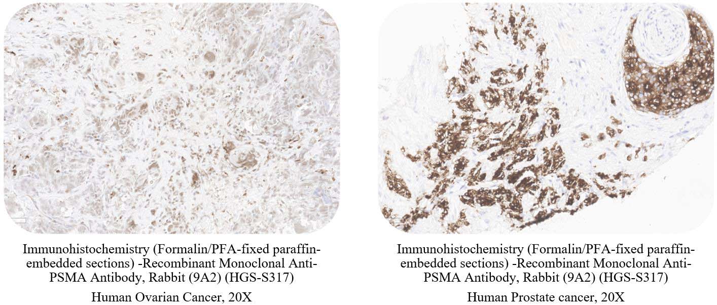 PSMA CANCER SAMPLE