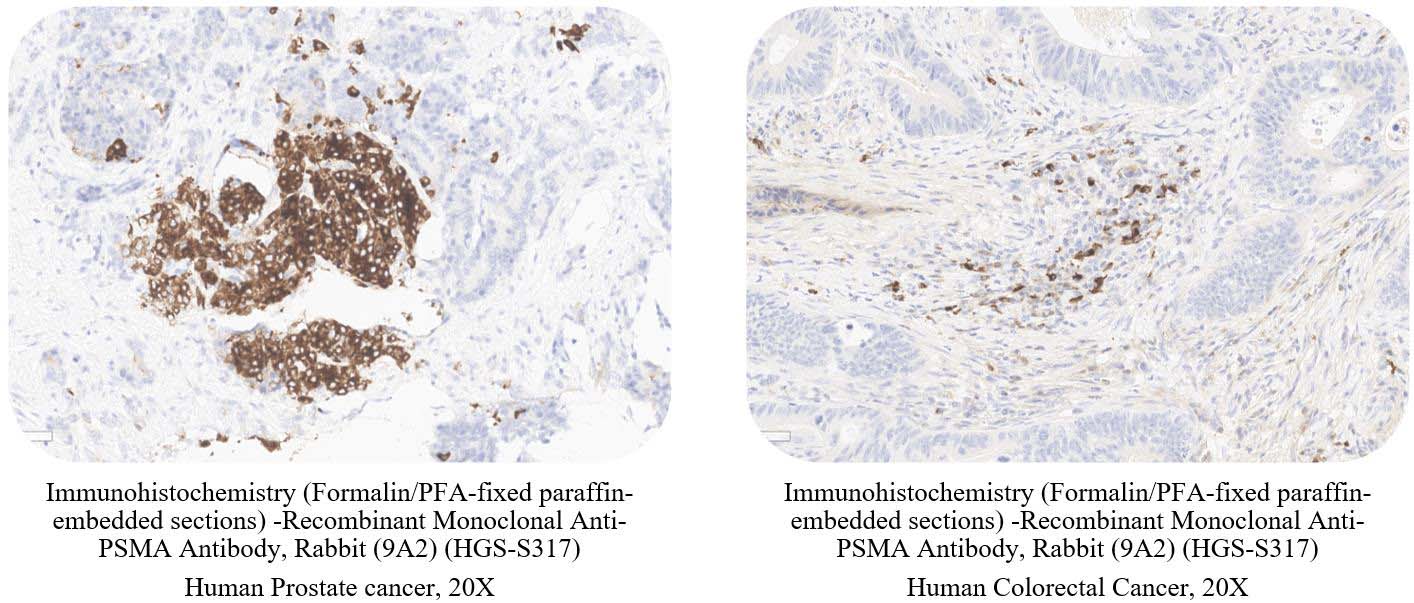 PSMA CANCER SAMPLE